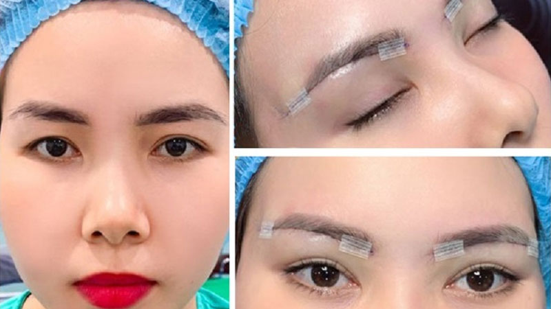 Nâng cung mày dưới với trường hợp lão hóa nặng