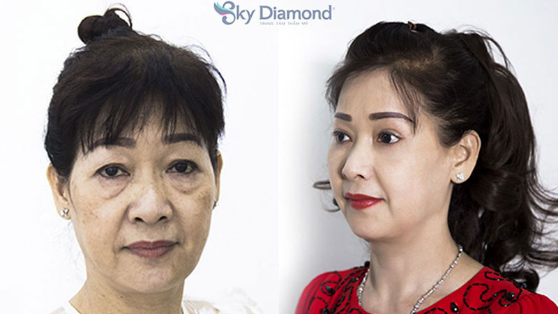 Nâng cung mày giúp cải thiện tướng số