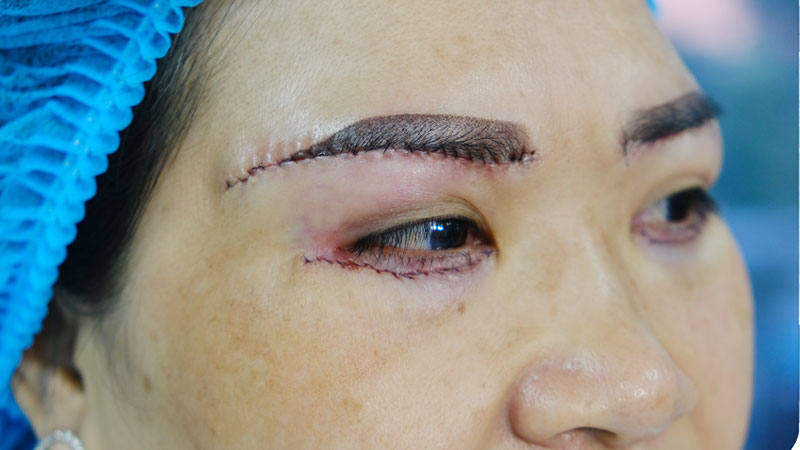 Nâng cung mày bằng chỉ không để lại sẹo