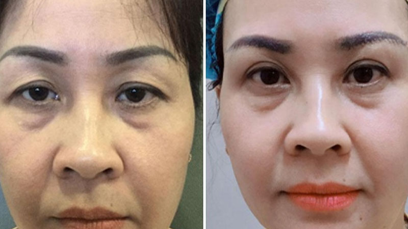Treo cung chân mày có nguy hiểm không?