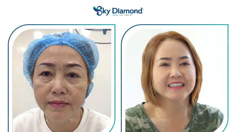 Treo mày xong lông mày hài hòa cân đối